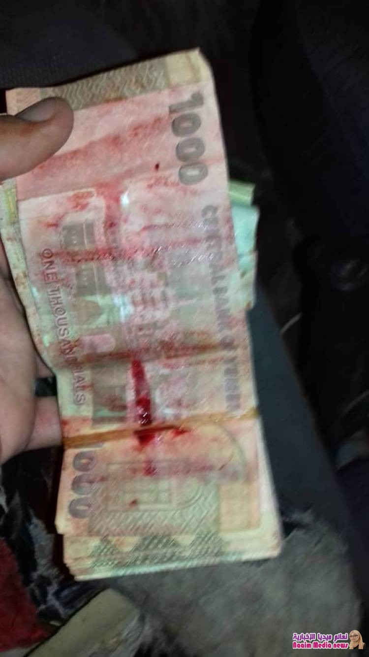 احدى نتائج ممارسة جرائم الحوثي بزرع الالغام