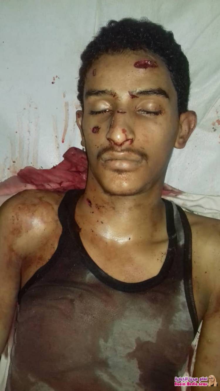 احدى نتائج ممارسة جرائم الحوثي بزرع الالغام