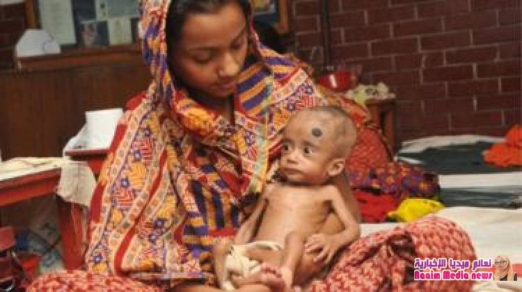 سوء التغذية: الموز والحمص والفول السوداني أفضل أغذية لعلاج المرض