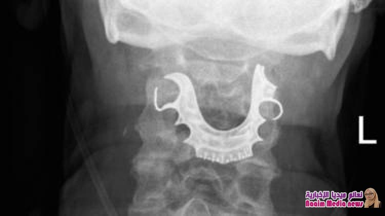 العثور على طقم أسنان في حلق مريض بعد أسبوع من خضوعه لجراحة