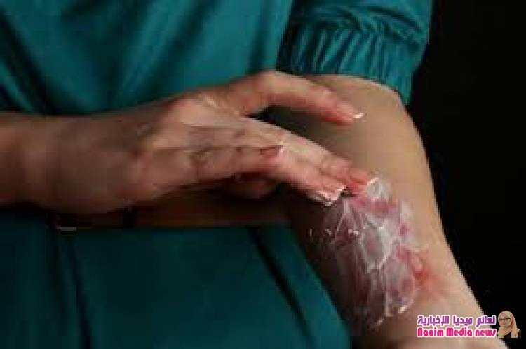 "التهاب الجلد العصبي" يهاجم البالغين .. مرض مزمن وأسباب مجهولة