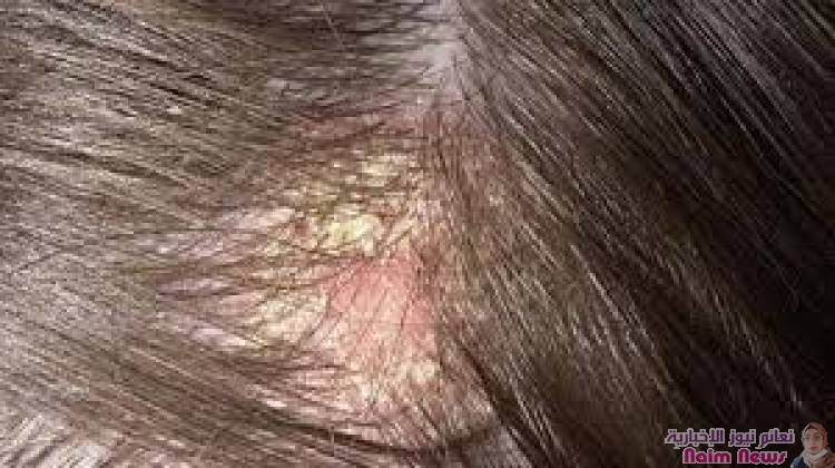 الالتهاب وتساقط الشعر .. علامات تنذر بفطريات الرأس لدى الأطفال