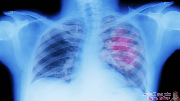 علامات لسرطان الرئة يمكن رؤيتها على الوجه!