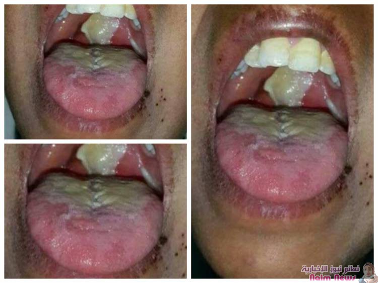 مديرة التثقيف والاعلام الصحي بعدن تدق ناقوس الخطر من انتشار مرض الدفتيريا بين الأطفال .