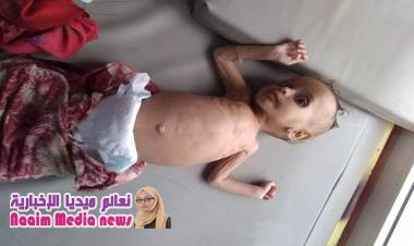عودة مخيفة لـ"سوء التغذية".. الحصار الحوثي يقتل أطفال التحيتا جوعاً