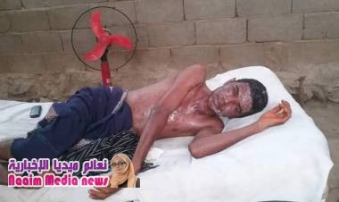 انتشار الجدري باليمن