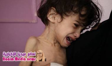 يونيسف: أطفال اليمن يموتون بسبب احتجاز الحوثيون للمساعدات