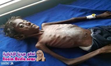 18 حالة وفاة.. سوء التغذية الوخيم يفتك بـ 350 طفلاً نازحاً في الخوخة