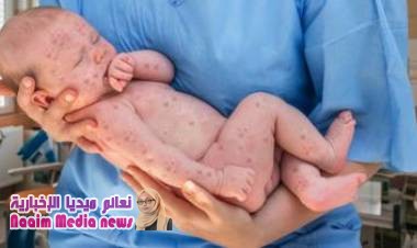 الحصبة: ثماني "خرافات" عن لقاح المرض تساهم في انتشاره