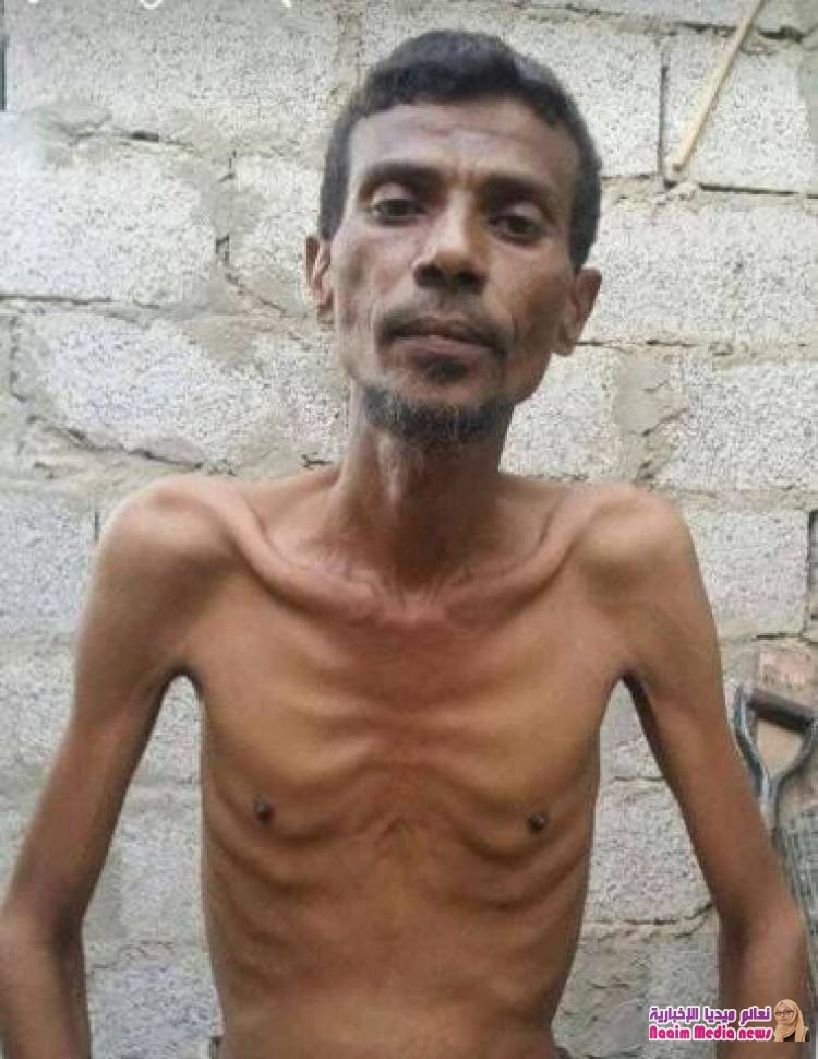 وفاة فنان تهامي بسبب الجوع وناشطون ينشرون آخر صورة له قبل الوفاة