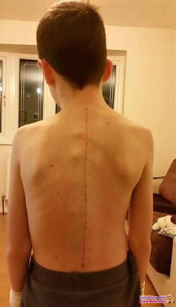 نجاح أول جراحة في العالم لتقويم العمود الفقري