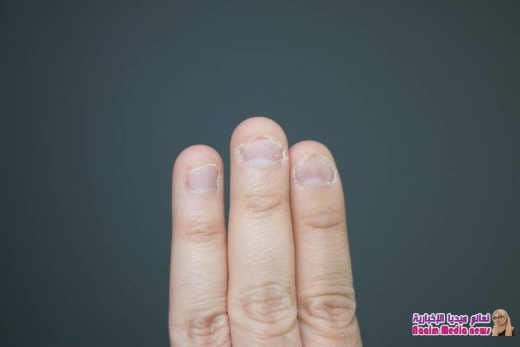  قضم الأظافر إشارة إلى معاناة طفلك