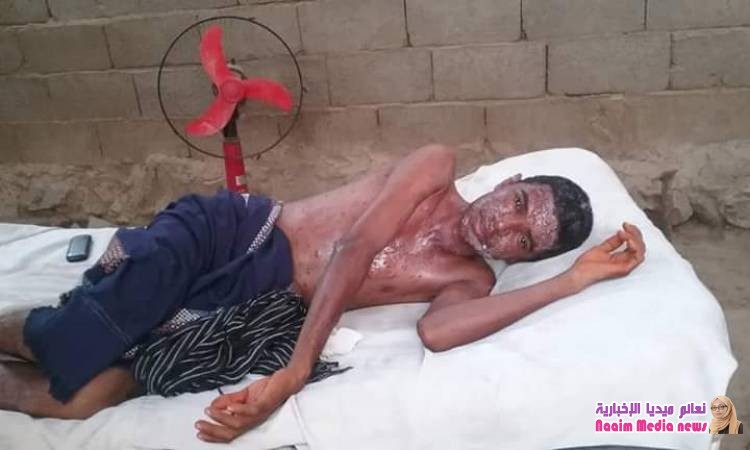 انتشار الجدري باليمن