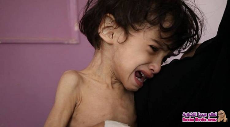 يونيسف: أطفال اليمن يموتون بسبب احتجاز الحوثيون للمساعدات