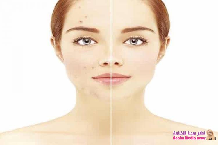 التخلص من آثار حب الشباب بالقرفة