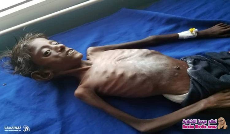 18 حالة وفاة.. سوء التغذية الوخيم يفتك بـ 350 طفلاً نازحاً في الخوخة