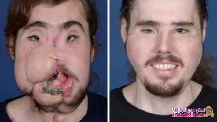 "استعدت ابتسامتي".. قصة شاب مع زراعة الوجه بعد محاولة انتحار