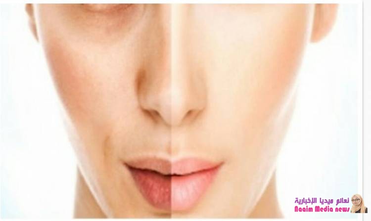 ماهية البوتوكس واستخداماته وكيفية حقنه وأعراضه الجانبية