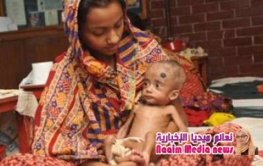 سوء التغذية: الموز والحمص والفول السوداني أفضل أغذية لعلاج المرض