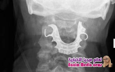 العثور على طقم أسنان في حلق مريض بعد أسبوع من خضوعه لجراحة
