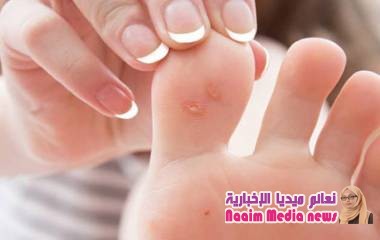 فقاعات القدم: أسبابها وطرق علاجها