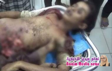 استشهاد 5 أطفال بانفجار عبوة ناسفة من مخلفات الحوثيين بالحديدة