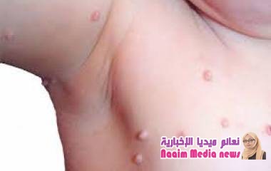 الثآليل لدى الأطفال .. المسابح وقاعات الألعاب في قفص الاتهام