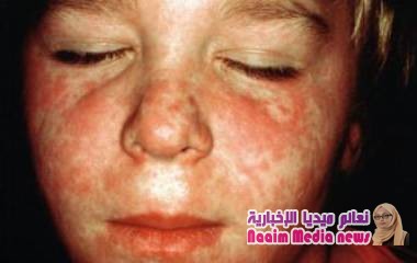 117 مليون طفل "قد لا يحصلون على تطعيم الحصبة في وقته"