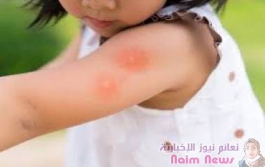 مرض الحساسية التلامسية لدى الأطفال .. الأعراض والأسباب