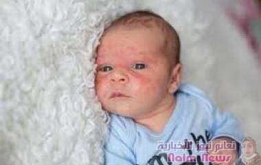 علام تدل البقع الجلدية الحمراء لدى الأطفال؟‎