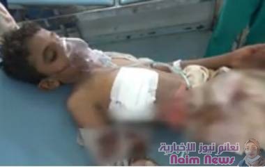 إصابة طفلين جراء انفجار مقذوف من مخلفات الحوثيين جنوبي الحديدة