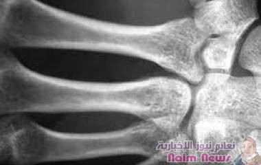 هشاشة العظام تهاجم مرضى السكري!