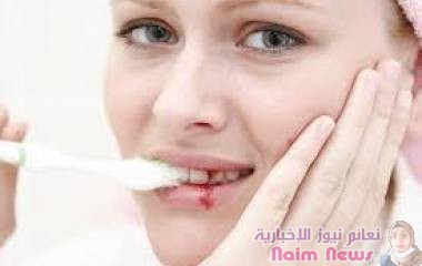 ما أسباب نزيف اللثة المتكرر؟