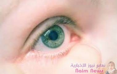 كيف تواجه "دمل الجفن"؟