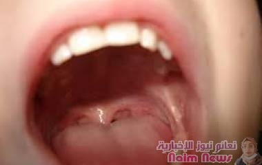 التهاب الغدد اللعابية .. أسباب وأعراض