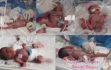 إمرأة تضع خمسة توائم في كوريا الجنوبية لأول مرة منذ 34 عاما