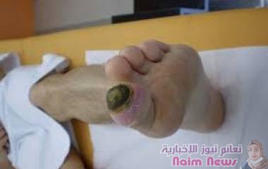 رابطة طبية: هذه الأعراض تنذر بمتلازمة القدم السكريرابطة طبية: هذه الأعراض تنذر بمتلازمة القدم السكري