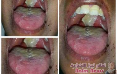 مديرة التثقيف والاعلام الصحي بعدن تدق ناقوس الخطر من انتشار مرض الدفتيريا بين الأطفال .